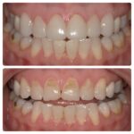 Facettes dentaires Vitrolles