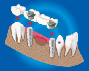 Implant, bridge ou dentier ?