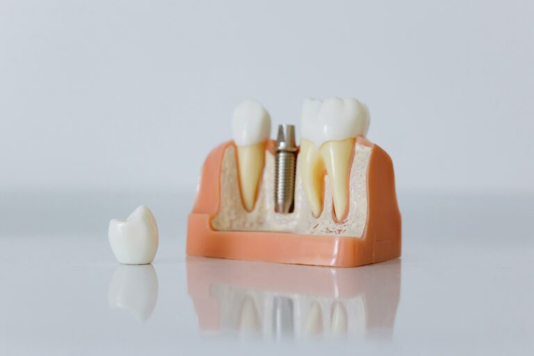 Suivi d'un implant dentaire chez un dentiste à Vitrolles