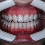 Comment corriger le jaunissement des dents après un traitement avec ondodontie avec gouttièrese via